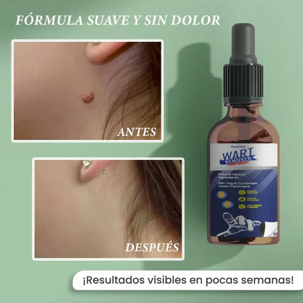DermaPure Verrugas – Aceite Natural para una Piel Suave y Libre de Verrugas